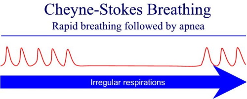 Cheyne-stokes